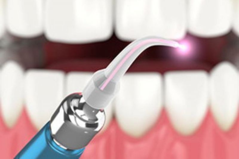 Laser Dentistry