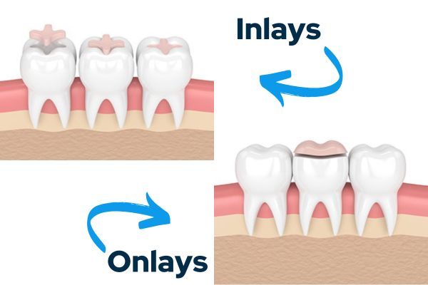 Inlays and Onlays