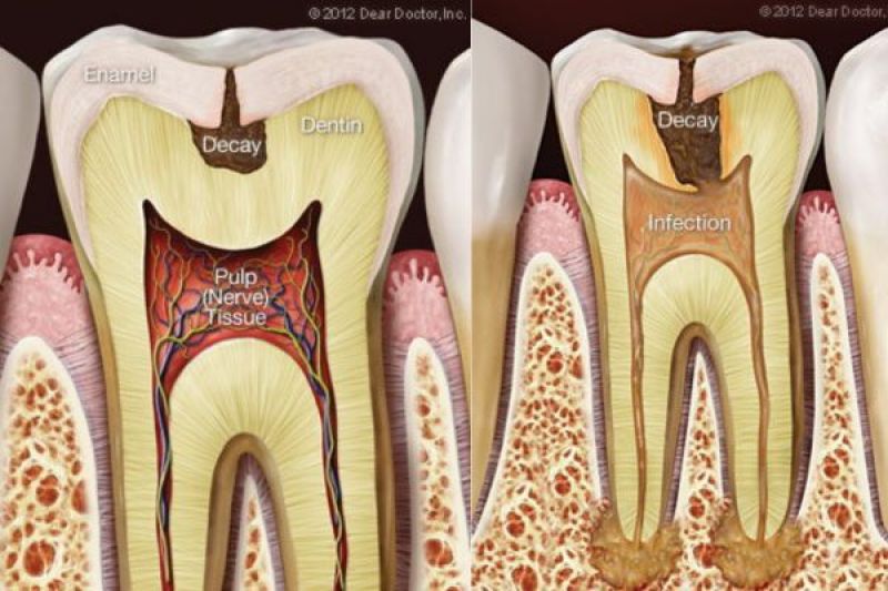 Tooth Pain