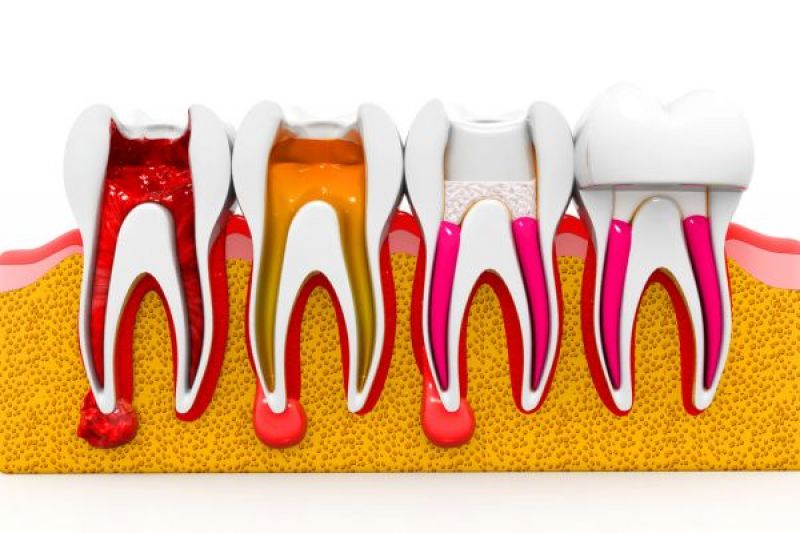 Root Canal Treatment FAQ