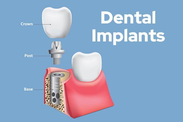 Dental Implant FAQs