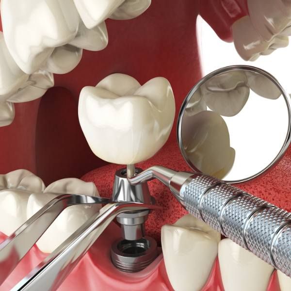 Dental Implant Services