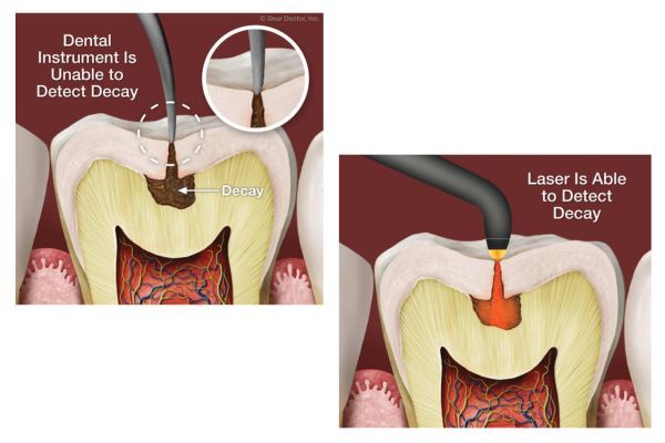 Laser Decay Diagnostics