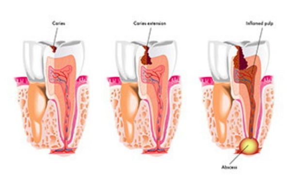 Tooth Decay Prevention