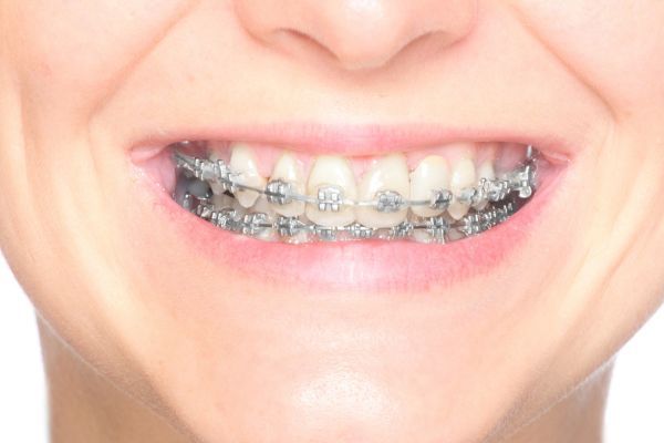 Orthodontic Emergencies