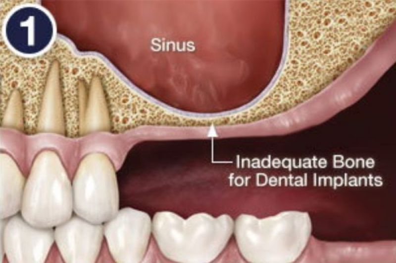 Sinus Surgery