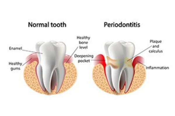 Periodontal Disease