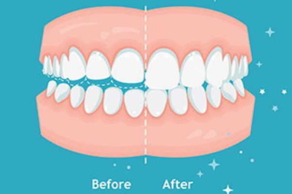 Bruxism