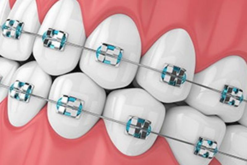 Types of Braces