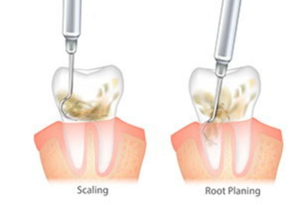 Non-Surgical Periodontal Procedures