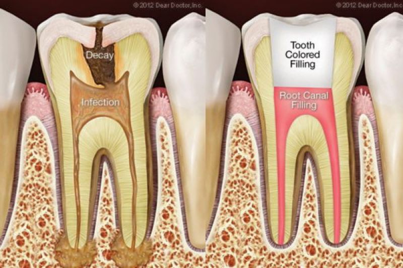 Root Canal Treatment