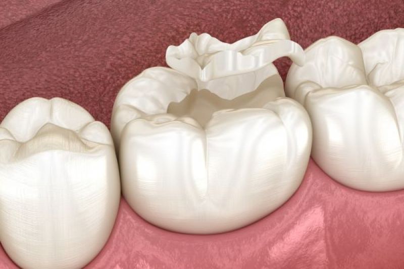 Tooth Colored Fillings