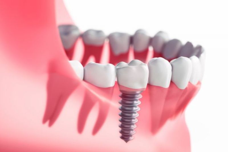 Dental Implants FAQs