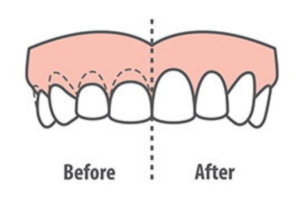 Crown Lengthening