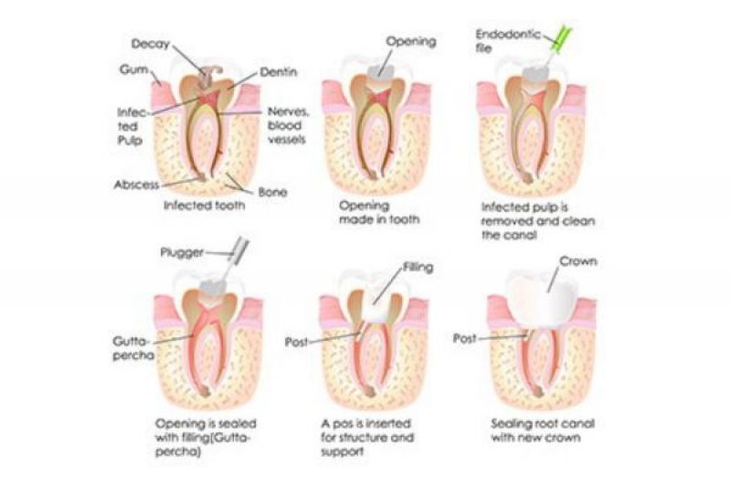 Root Canal Treatment