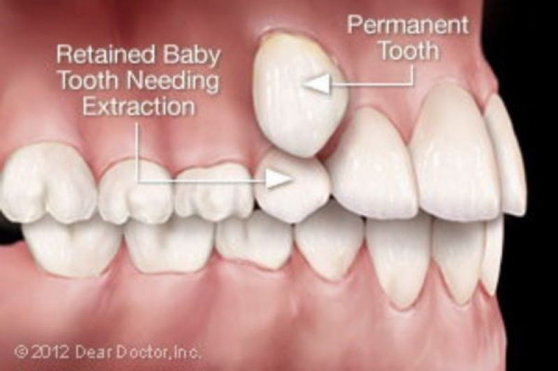 Extractions